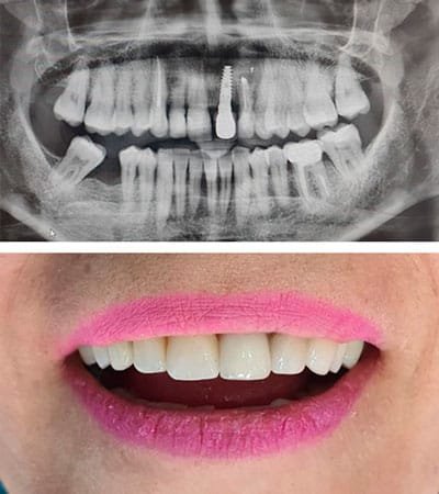 Prótesis Sobre Implantes Dentales Prótesis Sobre Implantes Dentales