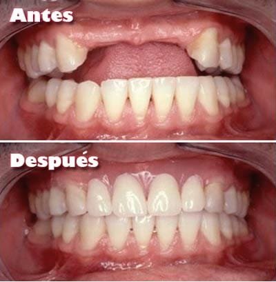 Implantes Dentales Antes y Después