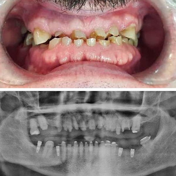 Implantes Dentales Antes
