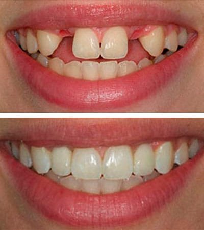 Implantes Dentales - Ejemplo Implantes Dentales - Ejemplo
