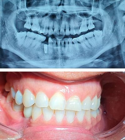 Implantes Dentales - Caso Clínico 21