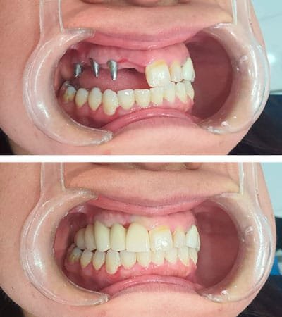 Prótesis Sobre Implantes Dentales Prótesis Sobre Implantes Dentales