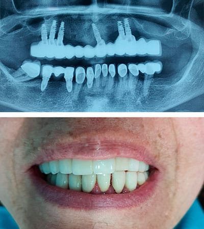 Prótesis Sobre Implantes Dentales Prótesis Sobre Implantes Dentales