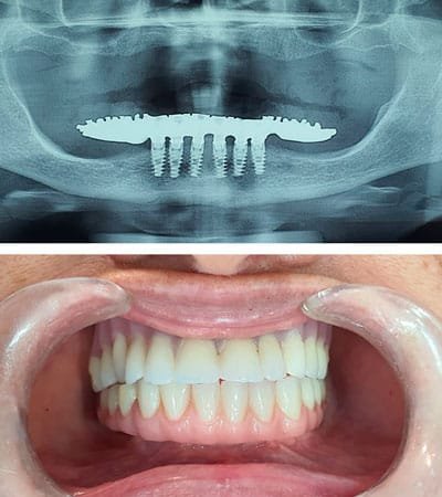 Prótesis Sobre Implantes Dentales Prótesis Sobre Implantes Dentales