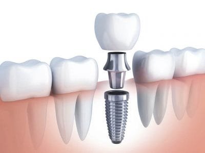 Implante Dental Unitario